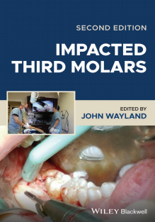 Impacted Third Molars 2nd Edition