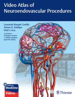 Video Atlas of Neuroendovascular Procedures 1st Edition