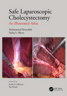 RRR-Mohammad Ibrarullah, Sadiq S Sikora - Safe Laparoscopic Cholecystectomy_ An Illustrated Atlas-CRC Press (2021)