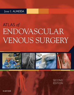  of endovascular venous surgery