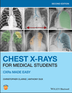 Chest X-Rays for Medical Students CXRs Made Easy 2nd Edition