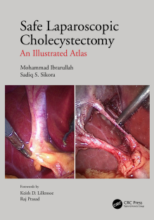 Safe Laparoscopic Cholecystectomy An Illustrated Atlas 1st Edition