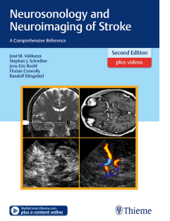 Neurosonology and Neuroimaging of Stroke a comprehensive reference